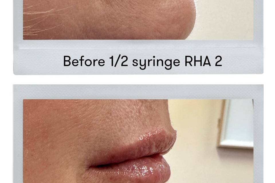 Subtle Lip Augmentation