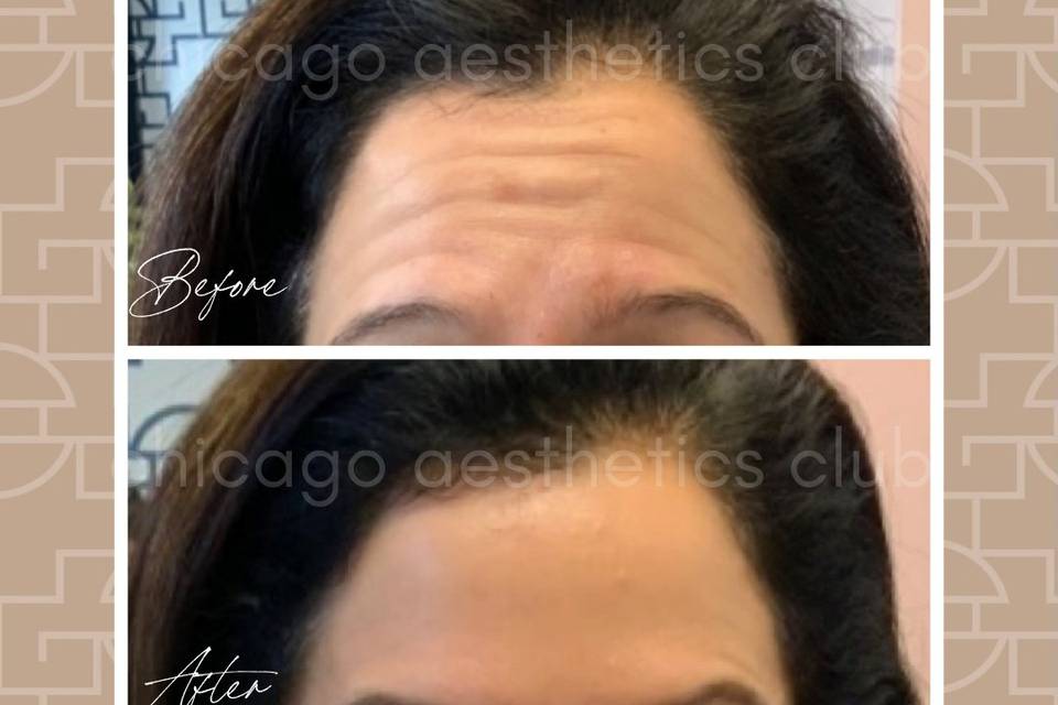 Dysport® for forehead wrinkles