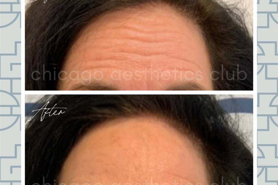 Botox® for forehead wrinkles