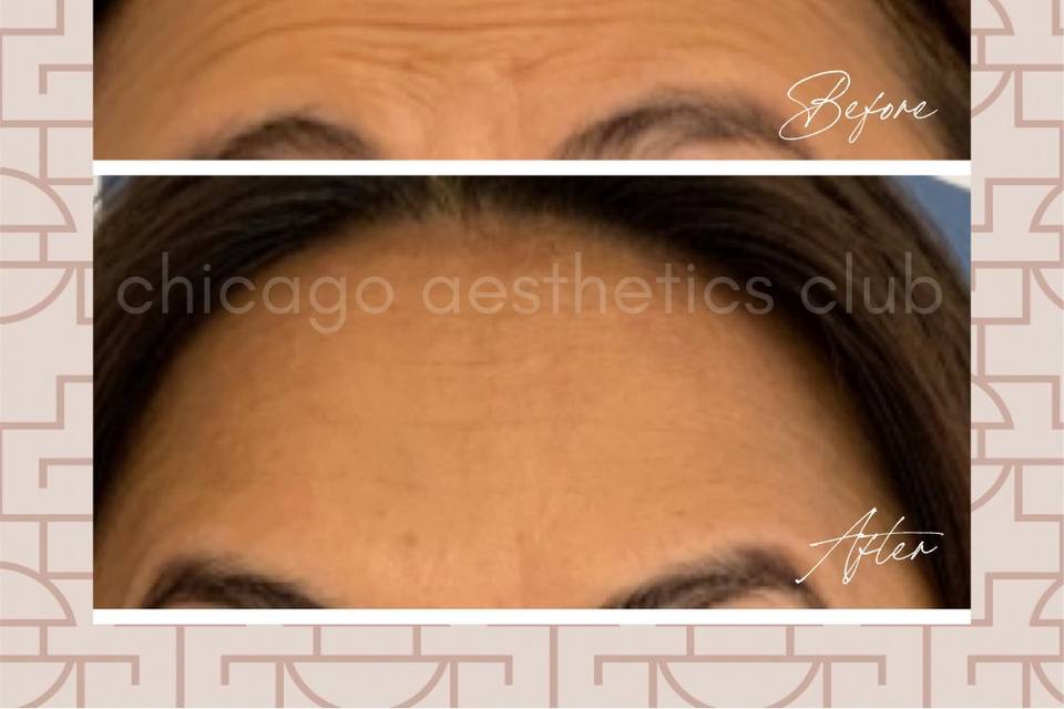 Botox® for forehead wrinkles
