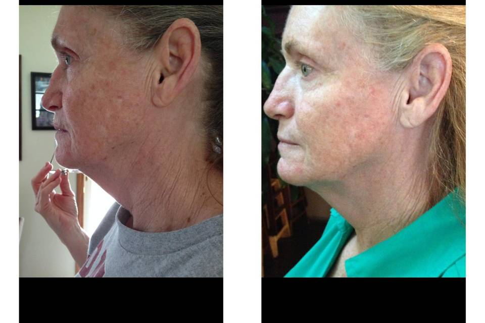 Customer results after 90 days.  Scars and discoloration improved. Skin texture is softer and smoother.