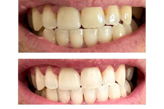 Teeth whitening results