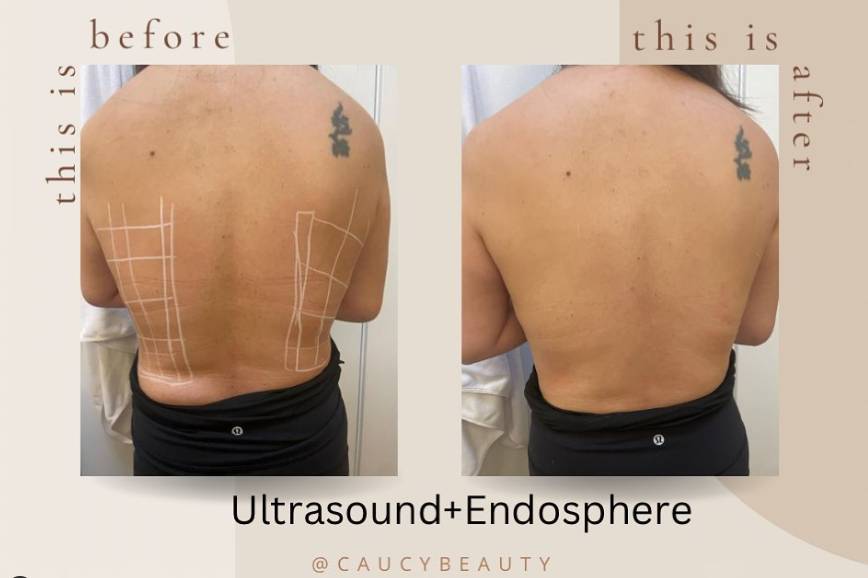 Ultrasound Body Treatment