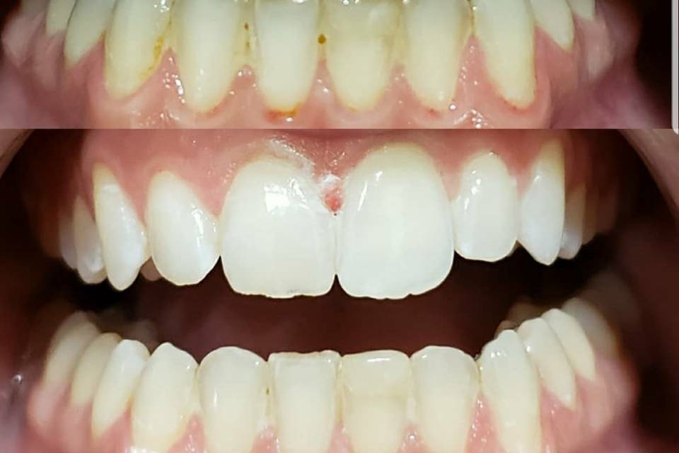 White teeth