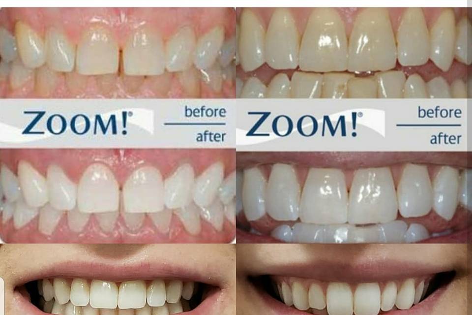 Zoom vs Smilelabs