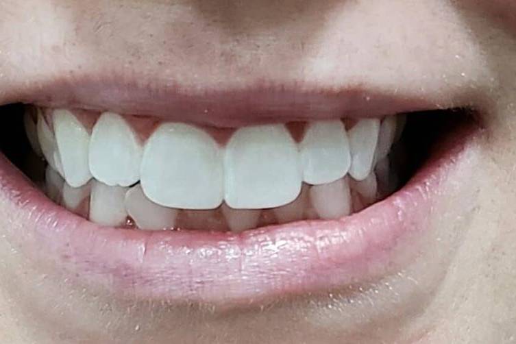 Healthy white teeth