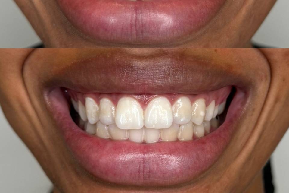 Teeth Whitening