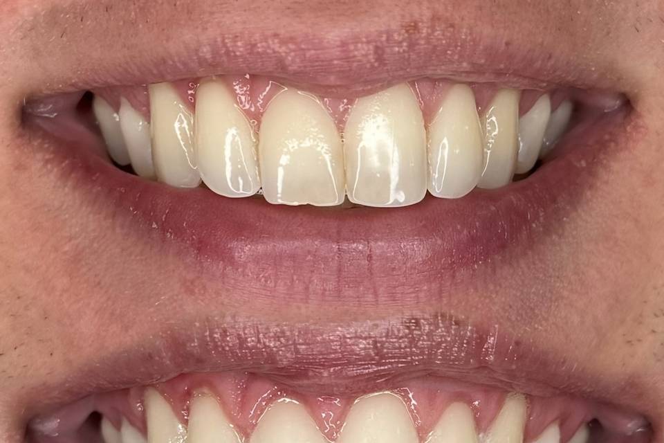 Teeth Whiteing