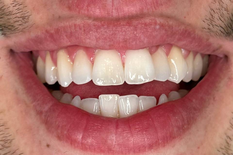 Teeth Whitening