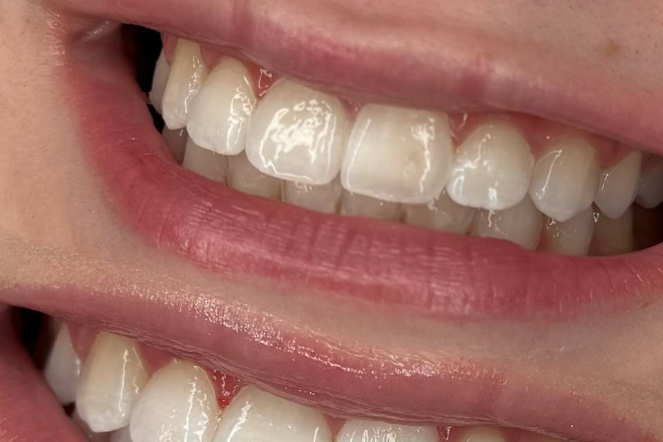 Teeth Whitening