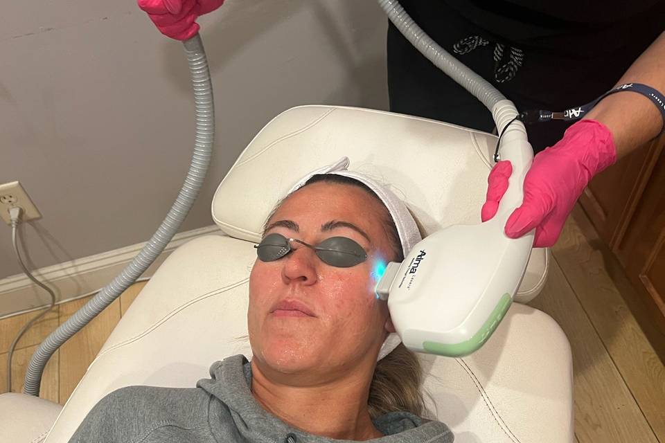 IPL Photofacial Laser