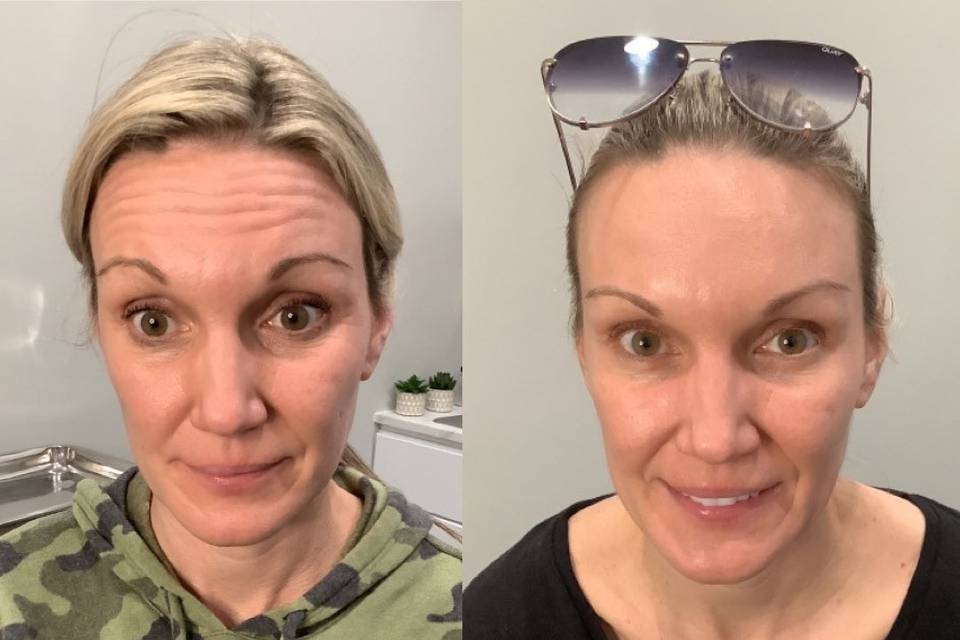 Forehead Botox treatment