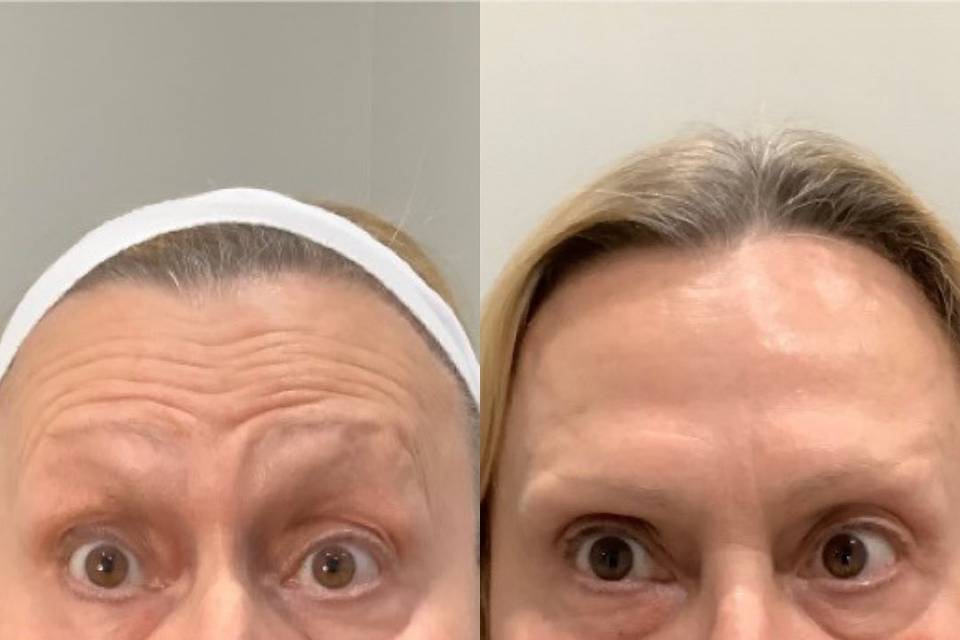 Forehead Botox treatment