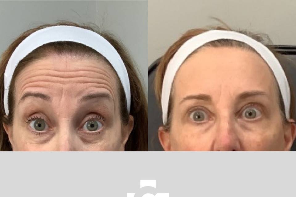 Forehead Botox treatment