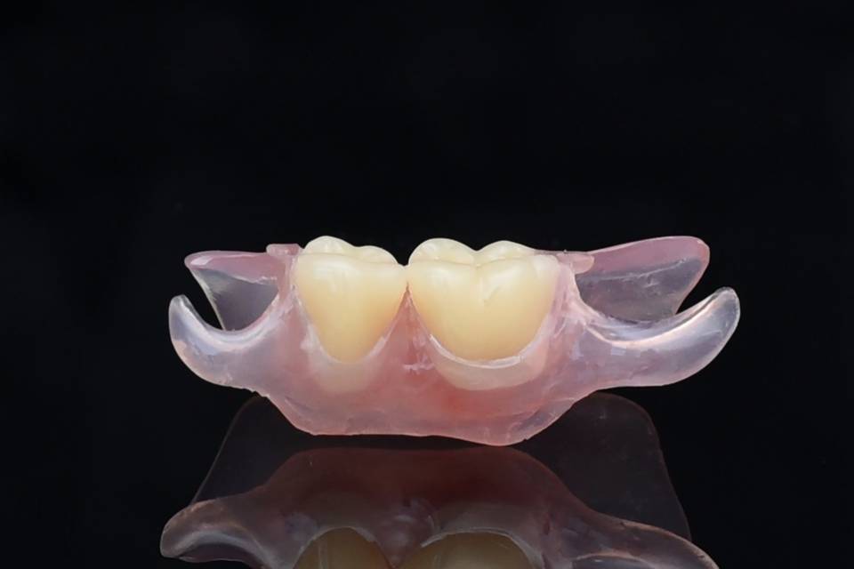 Nesbit 2 Tooth Partial Denture