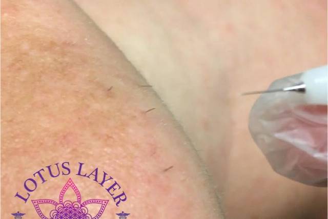 Electrolysis, the only fda-approved method of permanent hair removal.