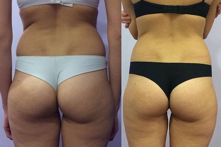 Velashape™ is a non-invasive body contouring treatment for circumferential and cellulite reduction that enables you to safely achieve a toned, contoured and well shaped body.