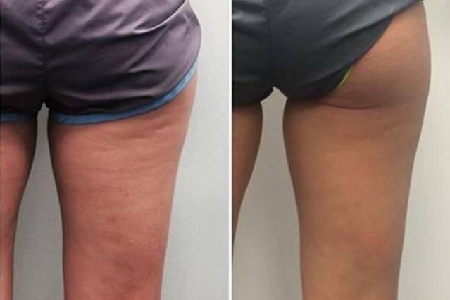 Velashape™ is a non-invasive body contouring treatment for circumferential and cellulite reduction that enables you to safely achieve a toned, contoured and well shaped body. 3 treatments