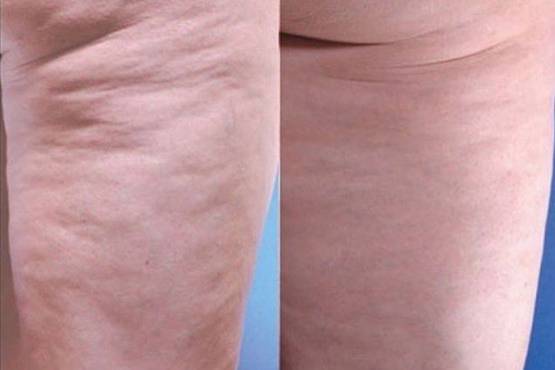 Velashape™ is a non-invasive body contouring treatment for circumferential and cellulite reduction that enables you to safely achieve a toned, contoured and well shaped body. 5 treatments