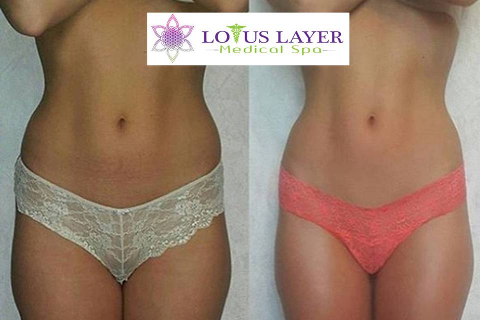 Velashape™ is a non-invasive body contouring treatment for circumferential and cellulite reduction that enables you to safely achieve a toned, contoured and well shaped body. 5 treatments