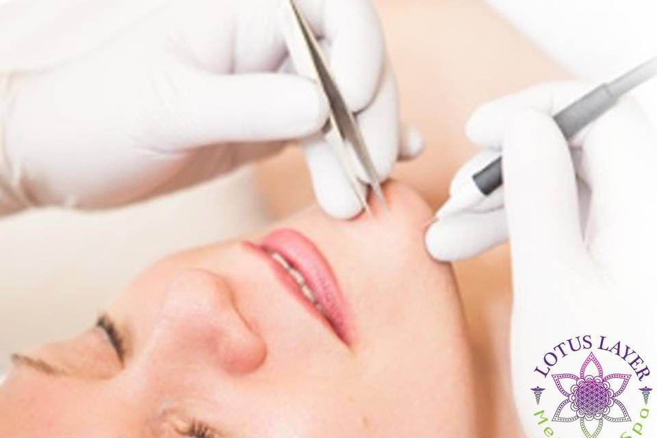 Do you suffer from embarrassing facial hair? Have you tried laser and still have hair? Are your hairs grey, blonde, white, or red? If you've answered yes to any of these questions, you may be a candidate for electrolysis, the only fda-approved procedure for permanent hair removal.