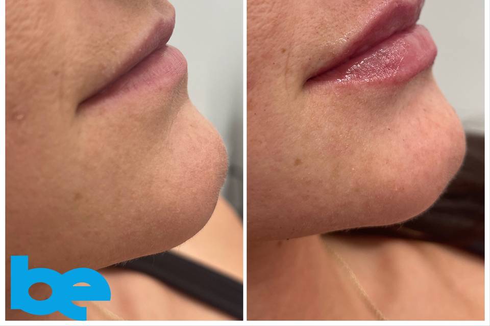 Lip filler before and after