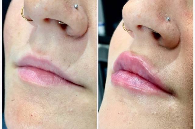 Kysse lips before and after