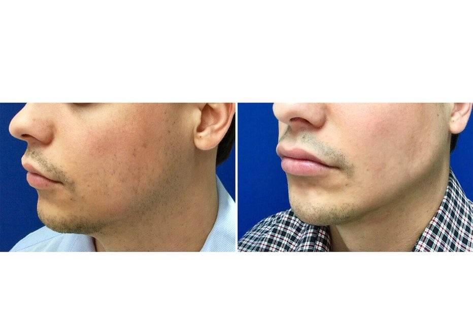 Jawline filler b and a