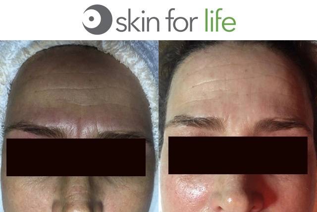 Microdermabrasion