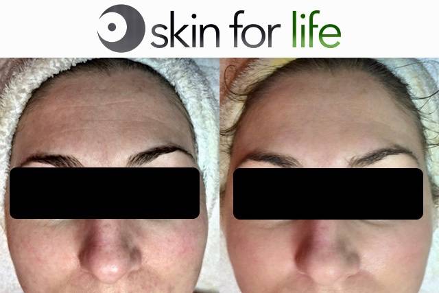 Chemical Peel & Oxygen Infusio