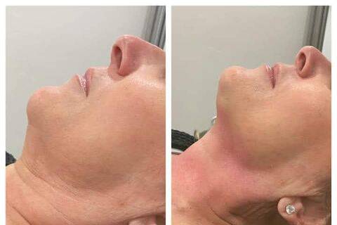Chin tuck