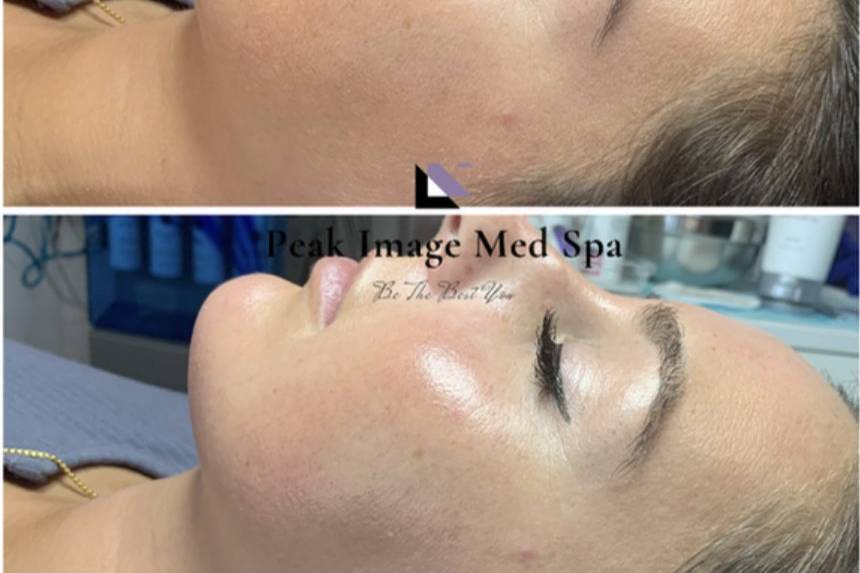 Dermaplane and HydraFacial