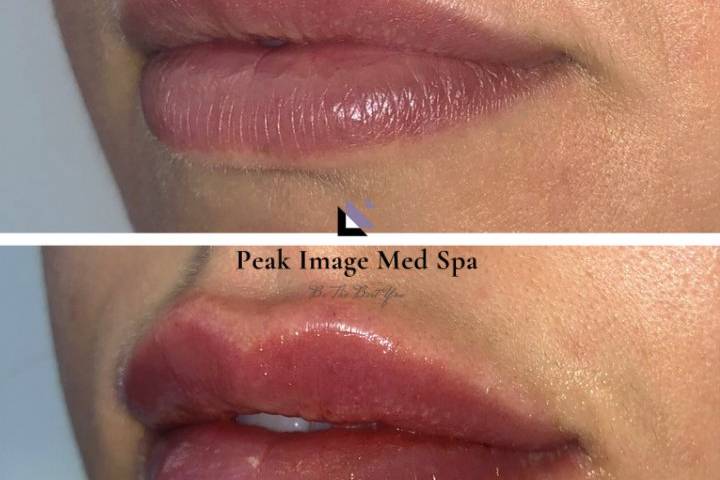 Lip augmentation with filler