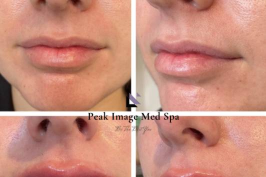 Lip augmentation with filler