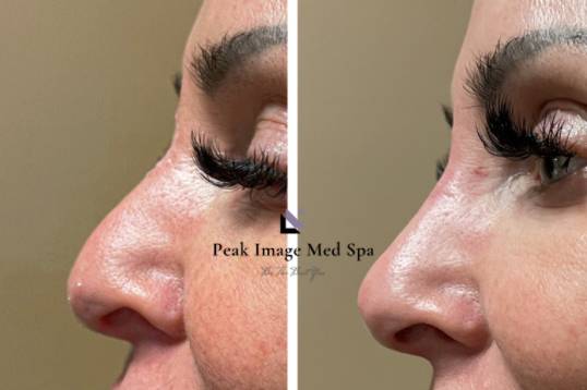 Liquid rhinoplasty