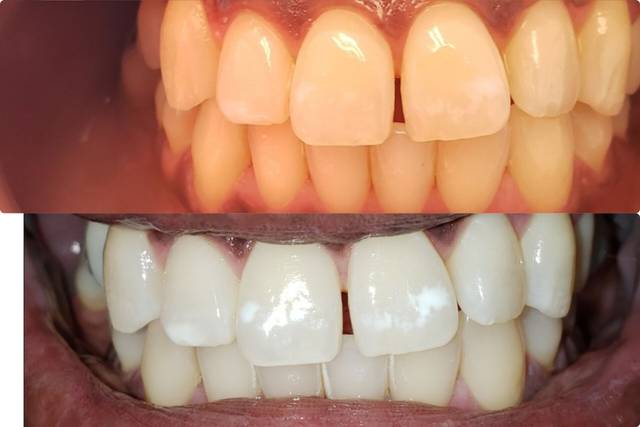 Closeup of teeth