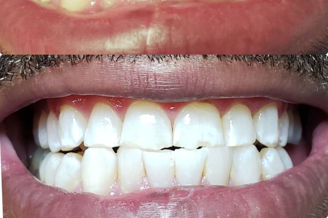 White teeth