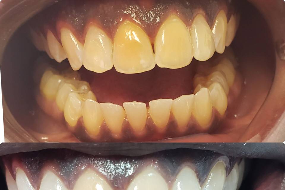 Teeth before and after