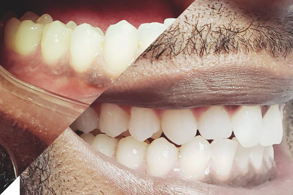 Teeth transformation