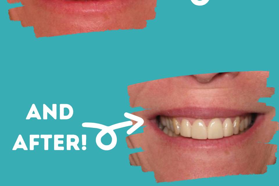 Veneers for a New Smile!